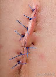 The area was irrigated with copious amounts of normal saline. What Are The Different Suture Techniques With Pictures