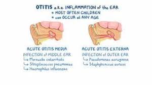 Image result for Acute Otitis Externa