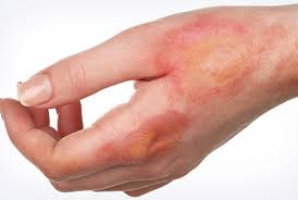 Pervaya Pomosh Pri Ozhogah Na Kuhne