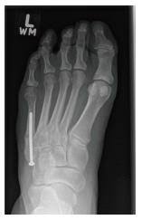 Doctor answers on symptoms, diagnosis, treatment, and more: Fifth Metatarsal Fractures And Current Treatment
