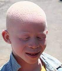 Down syndrome (ds), also known as trisomy 21, is the most common genetic disorder causing intellectual disability and the most frequently occurring human chromosomal syndrome. Black Asian Albino With Down Syndrome 9gag