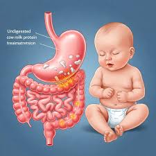 Image result for Lactase Deficiency