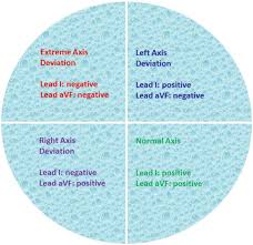 Image result for Right Axis Deviation