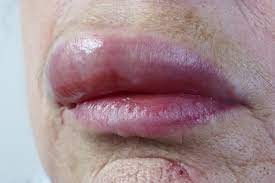 Razones Por Las Que Se Te Pueden Hinchar Los Labios