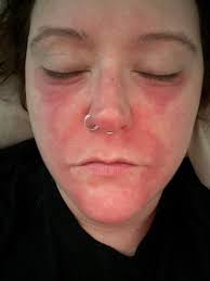 Is this contact dermatitis and how to cure it?