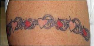 Rossio is a board certified plastic surgeon, surgical intensivist and house officer for various hospitals in northeast ohio and medical director of cosmetic rejuvenation center where we specialize in laser hair removal, laser tattoo removal, ipl treatments, botox, fillers and more. Laser Tattoo Removal Columbus Oh Tattoo Lightening Dublin