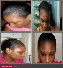 How To Treat Thin Edges Regrow Hair Regrow Hairline Stimulate Hair Growth