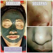 Gunakan krim yang mengandungi retinoids atau retinol. Cara Mudah Menghilangkan Blackhead Whitehead Di Hidung Mary Jardin Kelana Jaya Selangor Laviee
