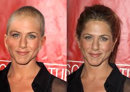 This procedure involves moving hair to thinning scalp areas from fuller areas. Optima Hair On Twitter Would Hollywood Movie Stars Be As Famous If They Were Bald Hair Loss Alopecia Http T Co 0ulepaikb9