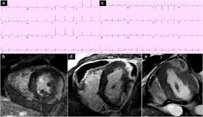 Autoimmune myocarditis and dilated cardiomyopathy: State Of The Art Evaluation And Prognostication Of Myocarditis Using Cardiac Mri Gannon 2019 Journal Of Magnetic Resonance Imaging Wiley Online Library