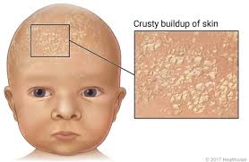 Image result for Cradle Cap