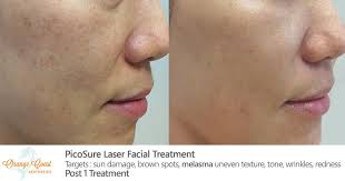 You guys make a huge difference! Picosure Laser Before And After Photos Irvine Ca Orange Coast Aesthetics