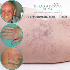 Image result for Photodermatitis