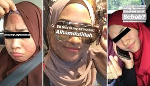 With all of the advancements in skin care today, there is much to be discovered. Bertahun Kulit Muka Teruk Camni Sebab Salah Skincare Tapi Sekarang Alhamdulillah The Reporter