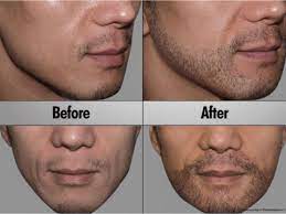 The cost per graft is normally more than the one extracted in any other hair transplant modality but here it's not because of the complexity of the extraction but the designing of the slits on the face in a way where it looks aesthetically pleasing. Beard Implants Transplants Explained Beard Transplant Body Hair Transplant Facial Hair Transplant
