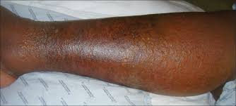 Image result for Stasis Dermatitis
