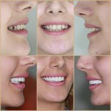 The Latest Smile Makeover With Gum Contouring In The Upper Jaw Dental Crowns Dental Veneers Dental Implant Procedure