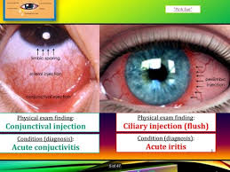 Image result for Ciliary Flush