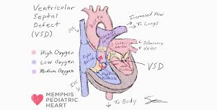 Image result for Ventricular Septal Defect