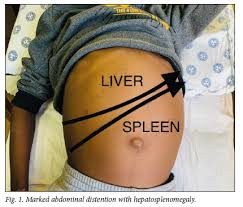 Image result for Splenomegaly