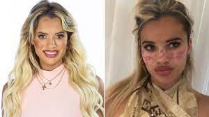 Tilly whitfeld is sharing what not to do. Big Brother Australia 2021 Star Tilly Whitfeld Reveals Why She Was Hospitalised After Attempting Tiktok Procedure Verve Times