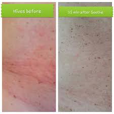 My Husband Broke Out In Hives Soothe Worked In Minutes Soothe Hives Breakouts