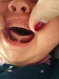 What does tongue tied mean? My Baby Won T Breastfeed I Think There S A Tongue Tie La Lactation Llc