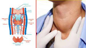 We did not find results for: Symptoms Of Thyroid Cancer In Females Uk Thyroid Cancer Wikipedia Thyroid Cancer Is A Cancerous Condition Of The Thyroid Gland Which Is Located In The Throat Just Below The Voice Box