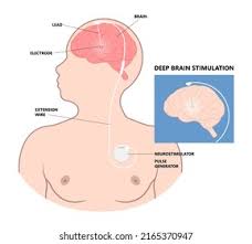 Image result for Thalamotomy