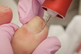 Ingrown Toenail Removal Near Me: What to Expect and How to Heal Faster
