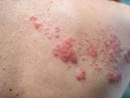 Most commonly, the rash occurs in a single stripe around either the left or. The Stages Of Shingles And How The Condition Progresses