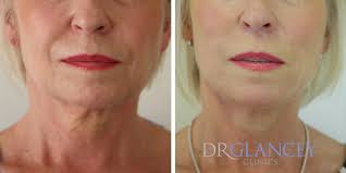 Check spelling or type a new query. Spring Thread Lift For The Face Dr Glancey Clinics