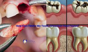Image result for Tooth Extraction
