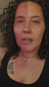 Harlequin Syndrome Babies