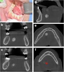 Image result for Sialolithiasis