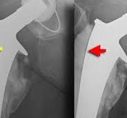 The Radiology Assistant : Arthroplasty of the Hip