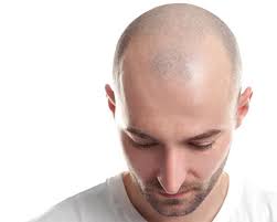 Our hair loss treatment & hair transplant clinic located in gurgaon delhi ncr is easily accessible. Hair Build Therapy Hair Fall Treatment Vlcc India