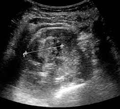 That means that out of 100 people, 53 people. Renal Cancer Clinical Features Management Teachmesurgery