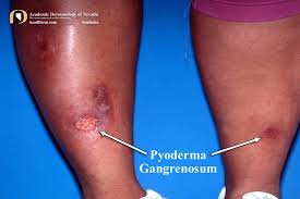Image result for Pyoderma Gangrenosum