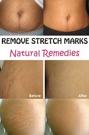 Natural Remedies That Can Remove Stretch Marks Beauty Glamour Stretch Marks Natural Beauty Remedies Stretch Mark Removal