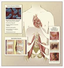 Image result for Spinal Epidural Abscess