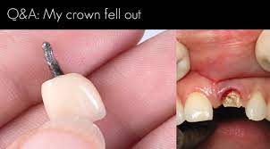 Check spelling or type a new query. My Crown Fell Out Windsor Dentists