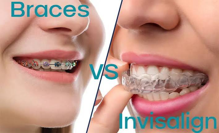 Invisalign Vs. Braces (The Pros and Cons of Each) Gibbs Orthodontic Associates
