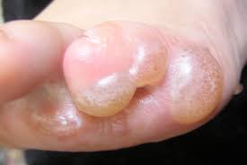 Maybe you would like to learn more about one of these? What Are The Different Types Of Eczema