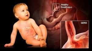 Image result for Pediatric Reflux