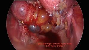 Laparoscopic view of pelvic endometriosis during surgery