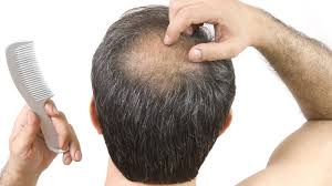 How do you fix thinning hair? Why Is There Stigma Around Male Baldness Bbc News