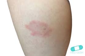 Lyme Disease