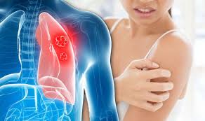 Lung cancer is a type of cancer that begins in the lungs. Lung Cancer Symptoms Tumor Signs Include Lumps And Bumps