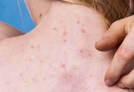 Lump On Neck Causes And Pictures